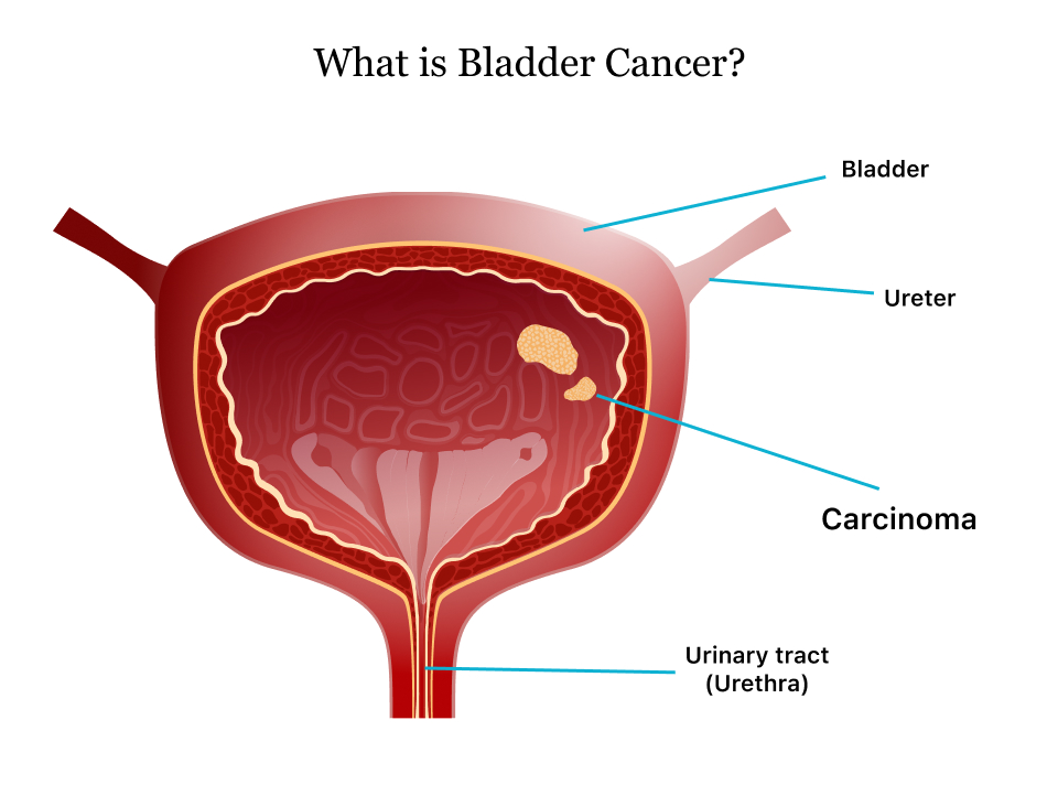 Bladder Cancer Treatments Image