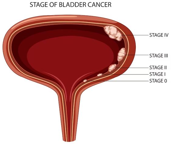 Types Of Bladder Cancer Image