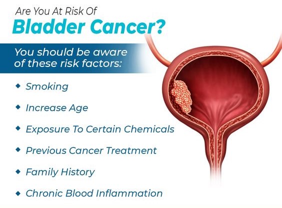 Causes of Bladder Cancer Images