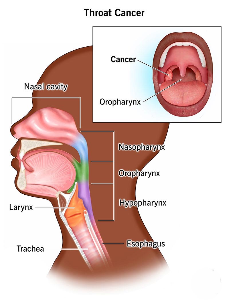 Throat Cancer Treatment Options​