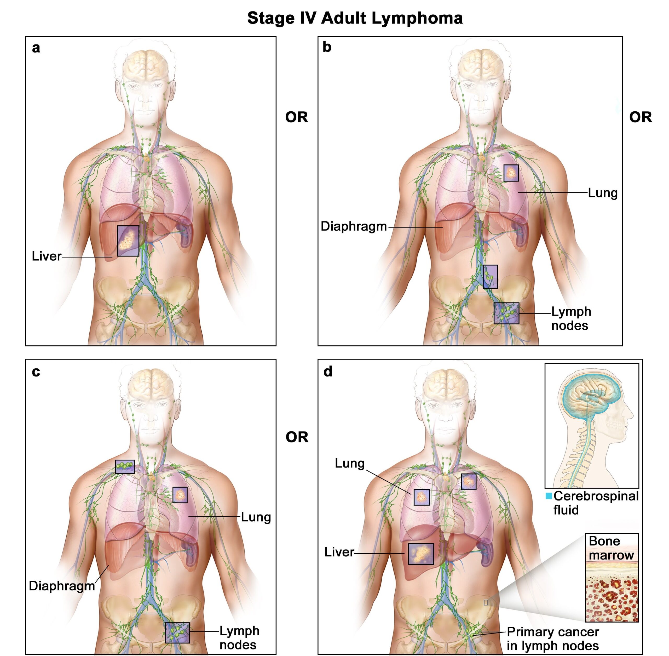 Types Of Hodgkin Lymphoma Cancer Image