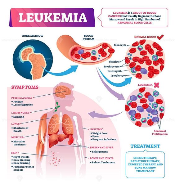 Leukemia Cancer Treatment Image