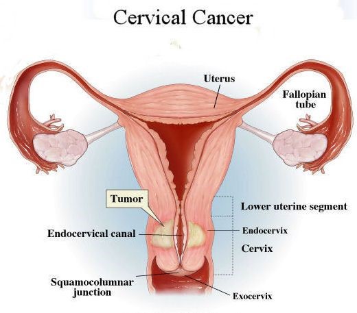 Cervical Cancer Treatments Image