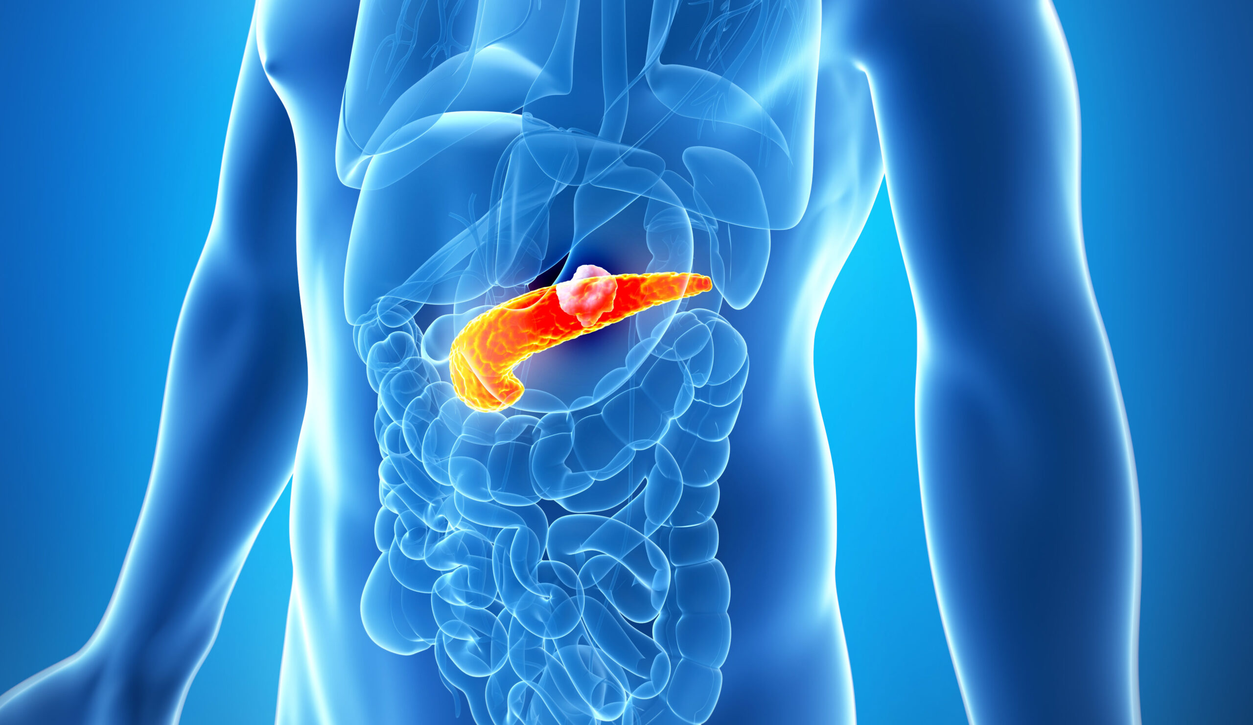 Risk Factors of Pancreatic Cancer​