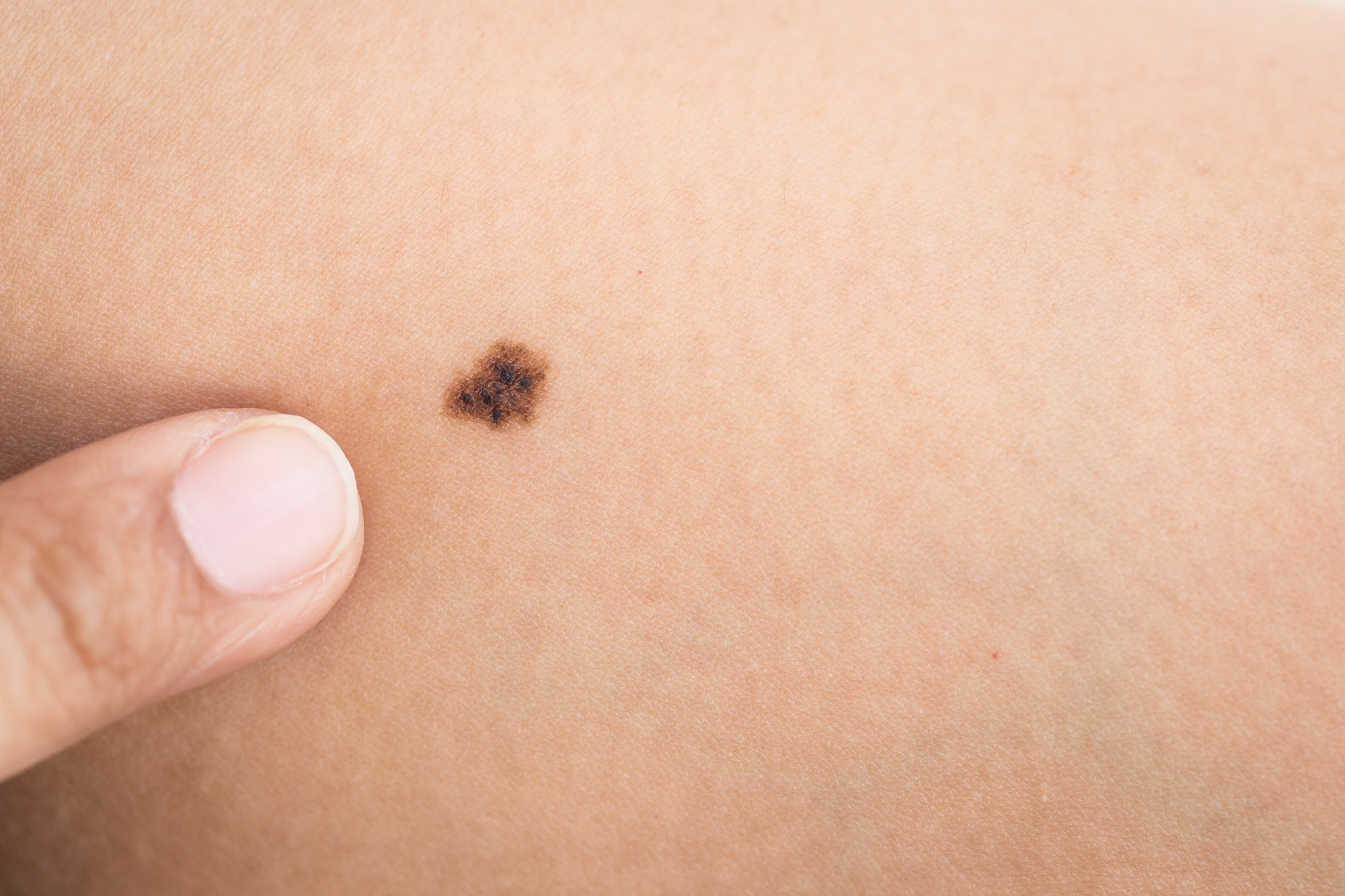 Types Of Skin Cancer​