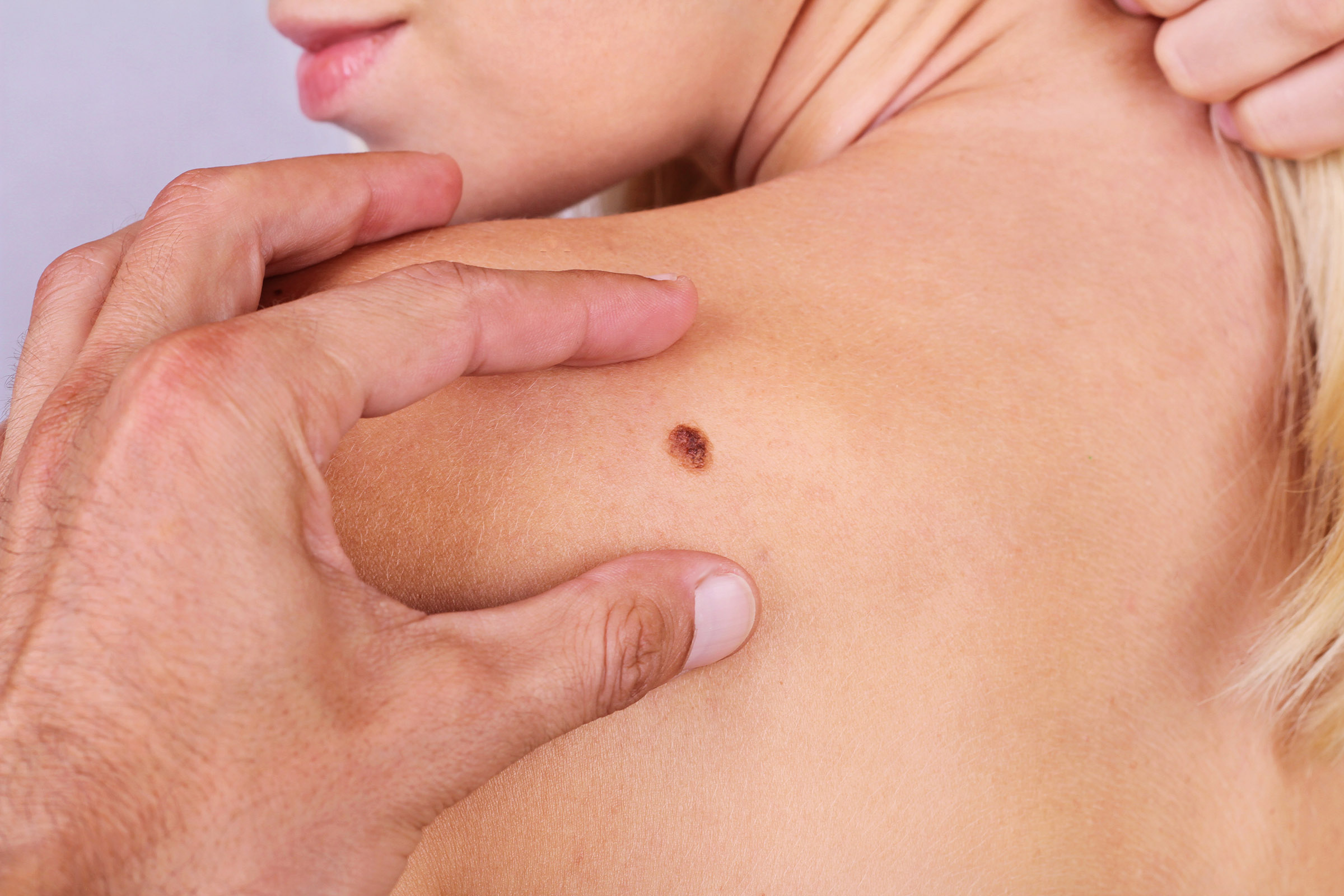 Risks and Common Causes of Skin Cancer​