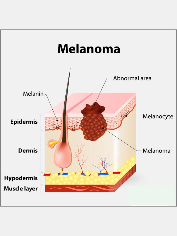 Causes Of Melanoma Cancer Image