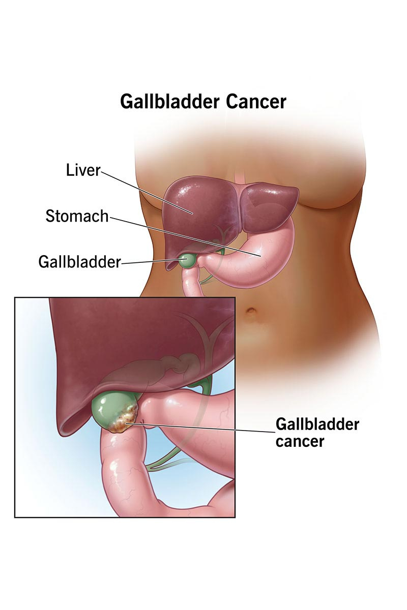 Gall Bladder Cancer Treatments Image