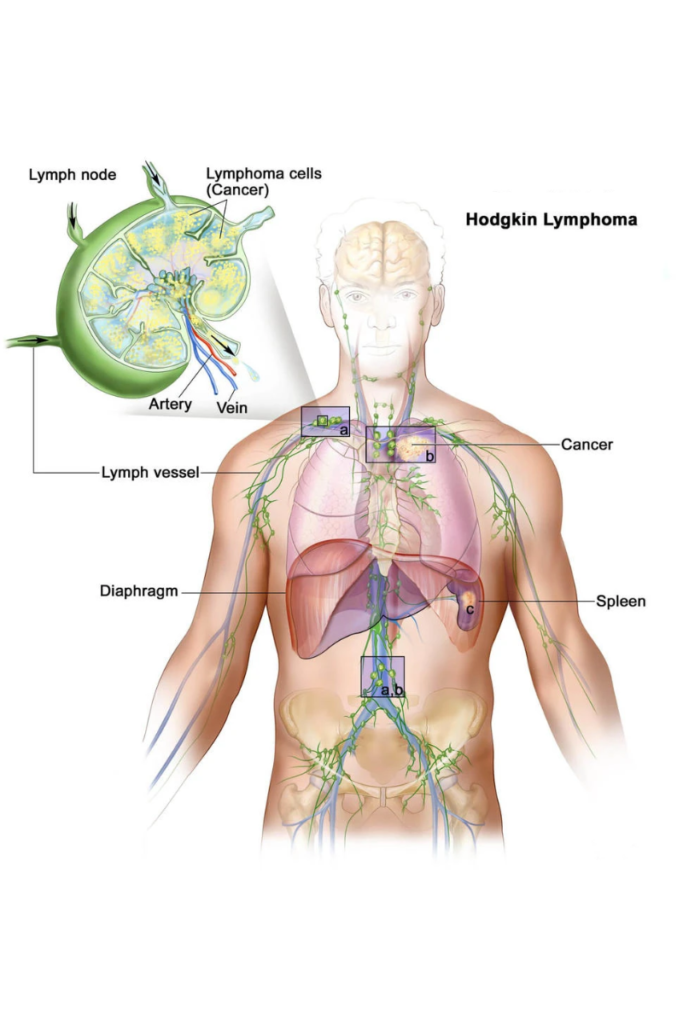 Hodgkin's Lymphoma Cancer - North Houston Cancer Clinics