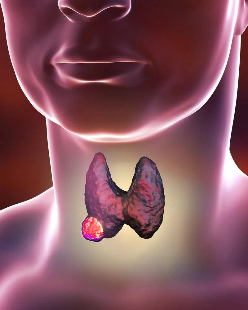 Prevention From Thyroid Cancer​