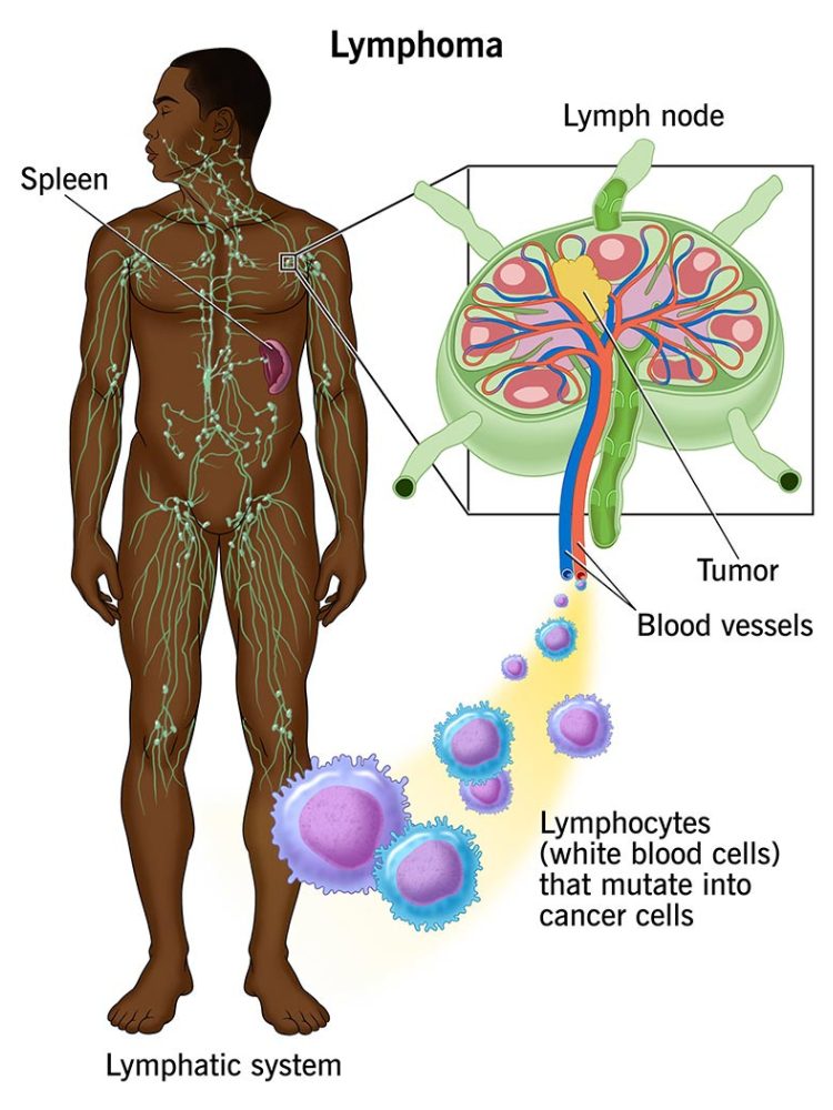 Lymphoma Cancer Treatments Image