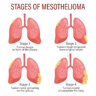 Stages Of Mesothelioma Cancer Image
