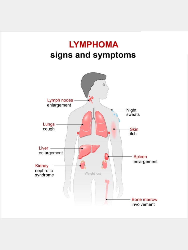 Symptoms Of Lymphoma Cancer Image