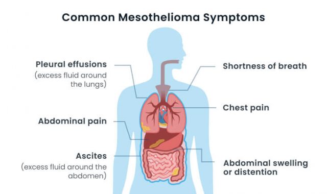 Symptoms Of Mesothelioma Cancer Image