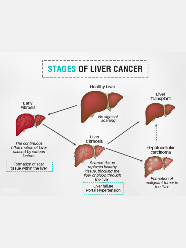 Types Of Liver Cancer Image