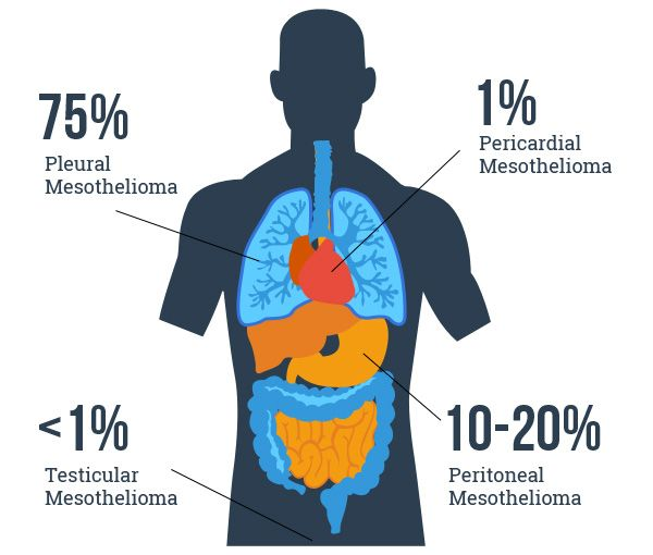 Types Of Mesothelioma Cancer Image