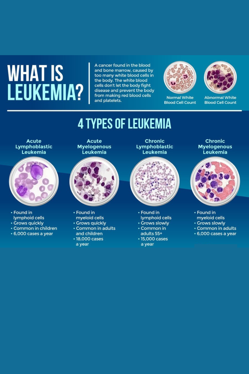 Types of Leukemia Cancer Image