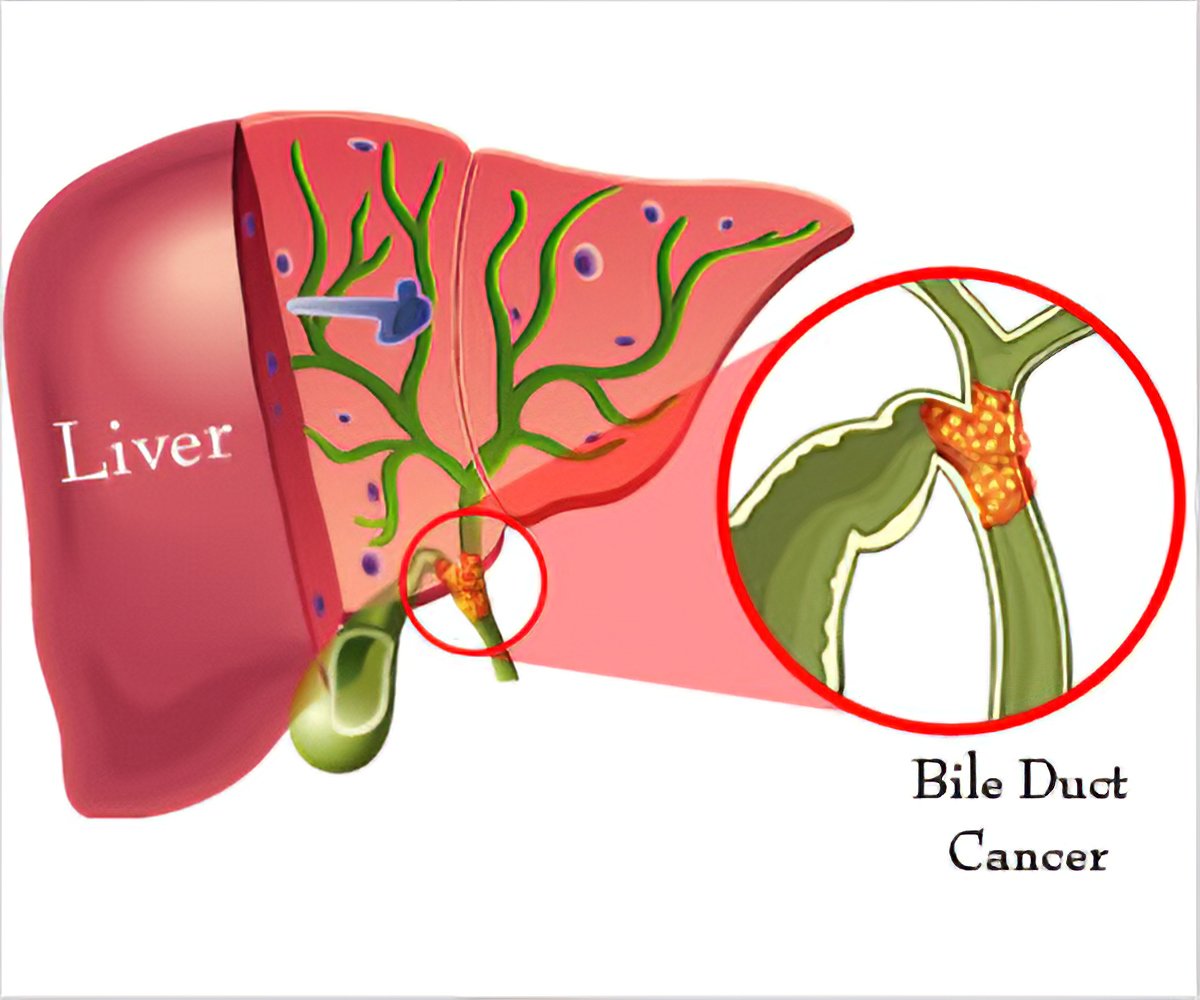 Bile Duct Cancer Image
