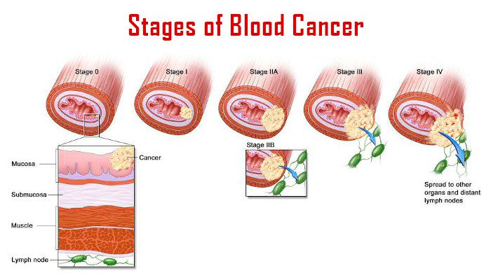 Types Of Blood Cancer Image