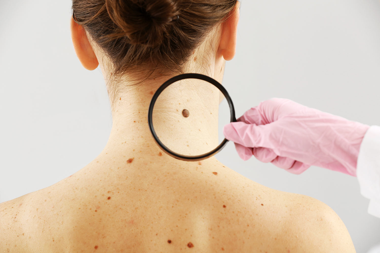 Skin Cancer Diagnosis​