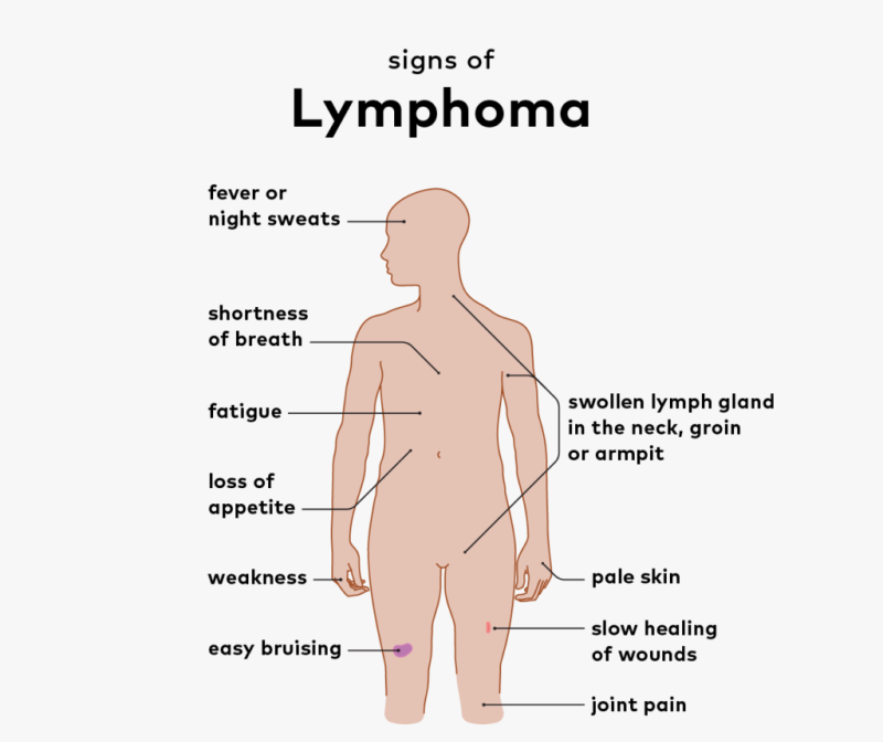 Symptoms Of Hodgkin Lymphoma Cancer Image