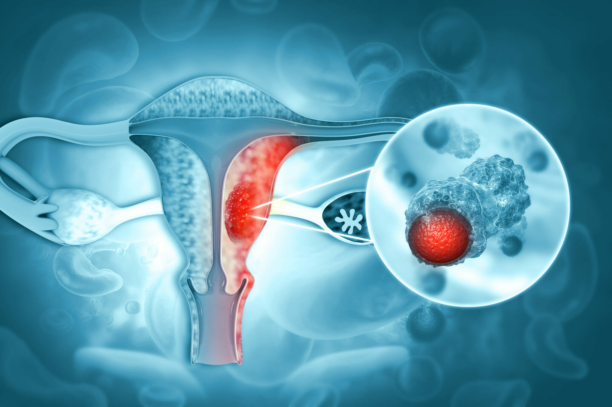 Warning Signs And Symptoms Of Uterine Cancer​