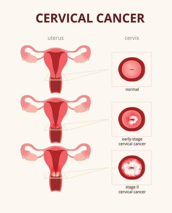 Types Of Cervical Cancer Image