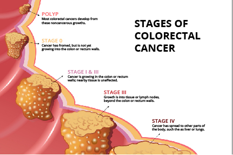 Types Of Colorectal Cancer Image