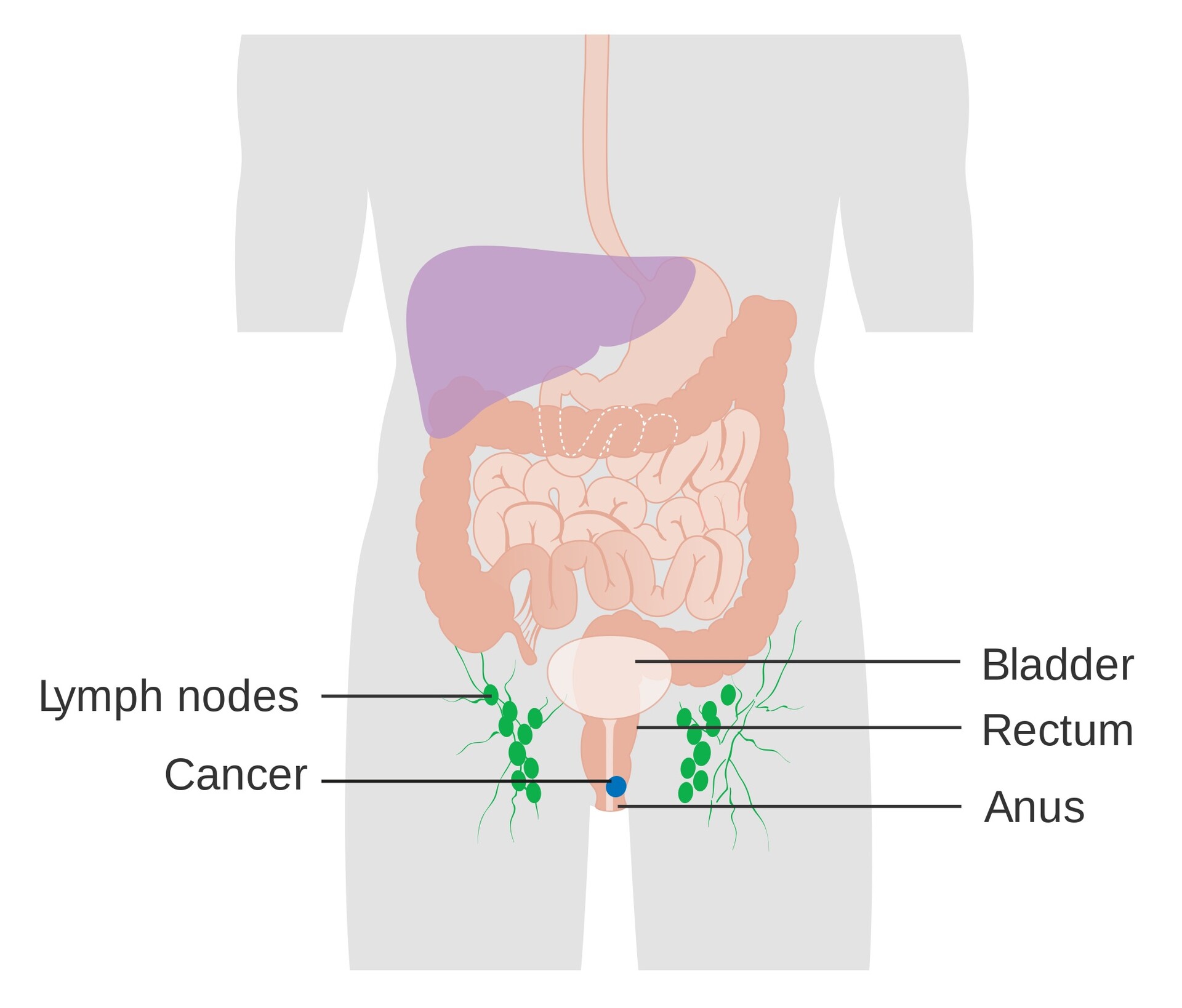 Anal Cancer Treatments Image