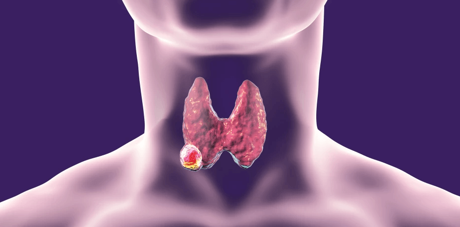 Treatments and Diagnosis Of Thyroid Cancer​