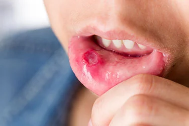 Mouth Ulcers and Oral Cancer